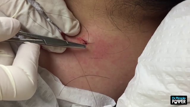 Această femeie avea pe gât un COȘ de trei ani. Când a ajuns la medic, acesta și-a pus mâinile-n cap când a văzut ce are.