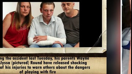 Schoolboy 14 is turned into a human fireball after aerosol can explodes during prank