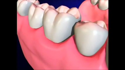 Why you may need a crown on top of your root canal.