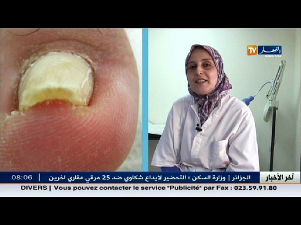 3دقائق ضحة: علاج فطريات الأظافر يستغرق وقتا .....