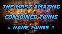 5 Most amazing conjoined twins # RARE TWINS