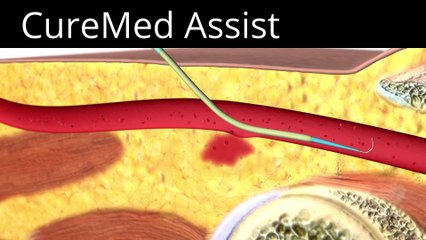 Sialorrhea Injection Site Identification 3D Medical Animation – CureMed Assist – Medical Tourism Company