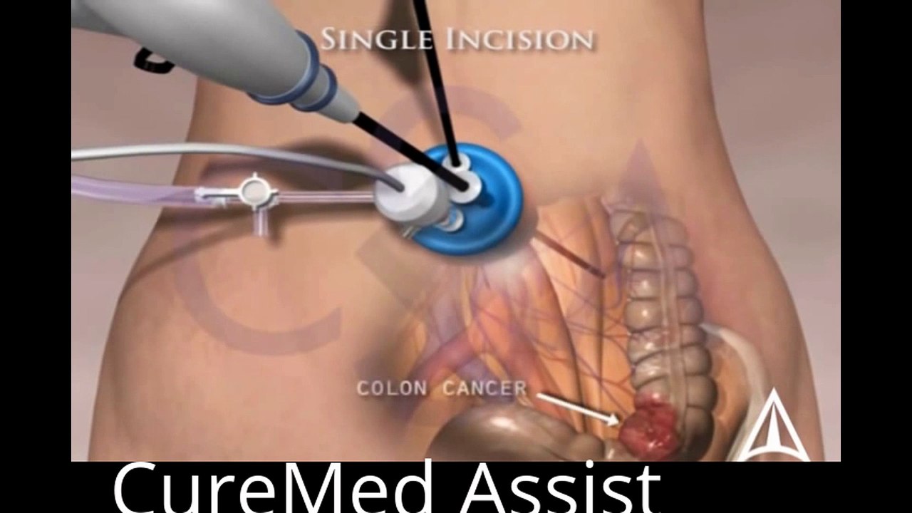 Single Incision Laparoscopic Colectomy utilizing SILS port 3D Medical Animation – CureMed Assist – Medical Tourism Company