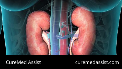 Stress Urinary Incontinence Leakage of Urine Injury to the Urethra – CureMed Assist – Medical Tourism Company