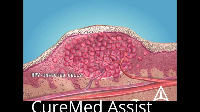 Skin Warts 3D Medical Animation – CureMed Assist – Medical Tourism Company
