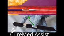 Supera Transhepatic Biliary System 3D Medical Animation – CureMed Assist – Medical Tourism Company