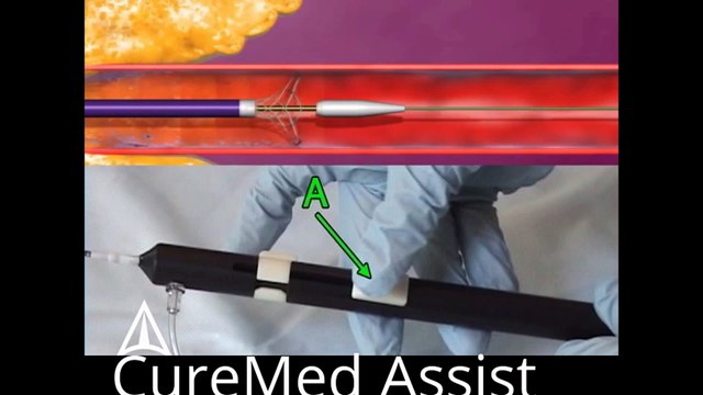Supera Transhepatic Biliary System 3D Medical Animation – CureMed Assist – Medical Tourism Company