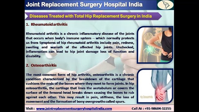 Total Hip Replacement Surgery in India - A New Route for a New Hip