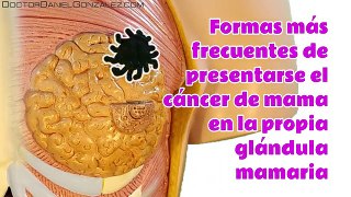 Sintomas de Cancer de mama