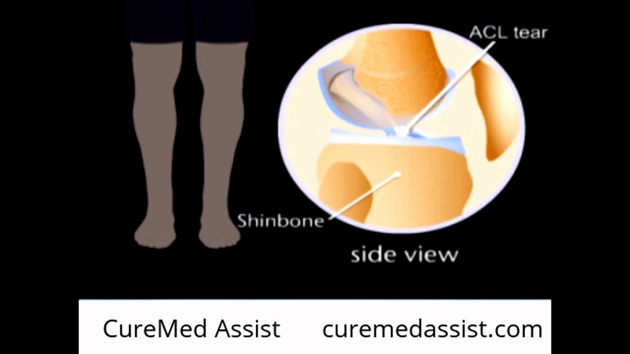 Tearing Your ACL – CureMed Assist – Medical Tourism Company
