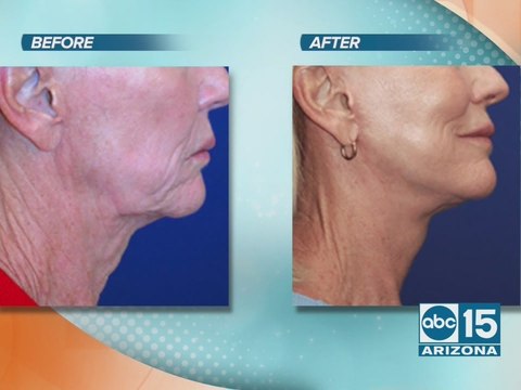Dermacare Cosmetic Surgery offers lasting beauty with Lasting Facelift