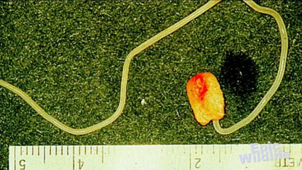 Deadly Human Parasite - Guinea Worm