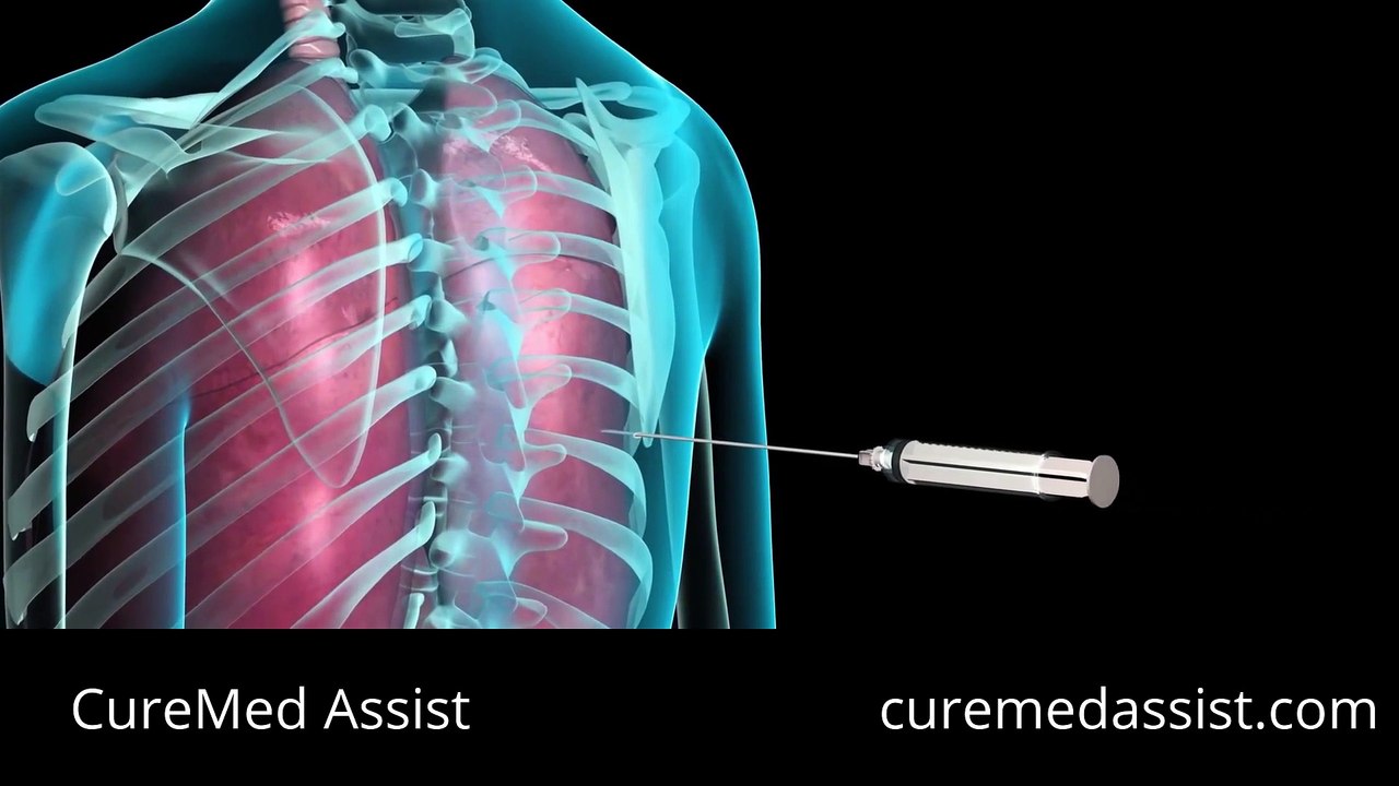 Transthoracic Needle Biopsy To Diagnose Lung Disease – CureMed Assist – Medical Tourism Company