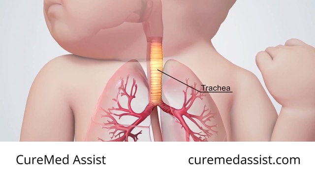 Surgery For Tracheoesophageal Fistula Repair – CureMed Assist – Medical Tourism Company