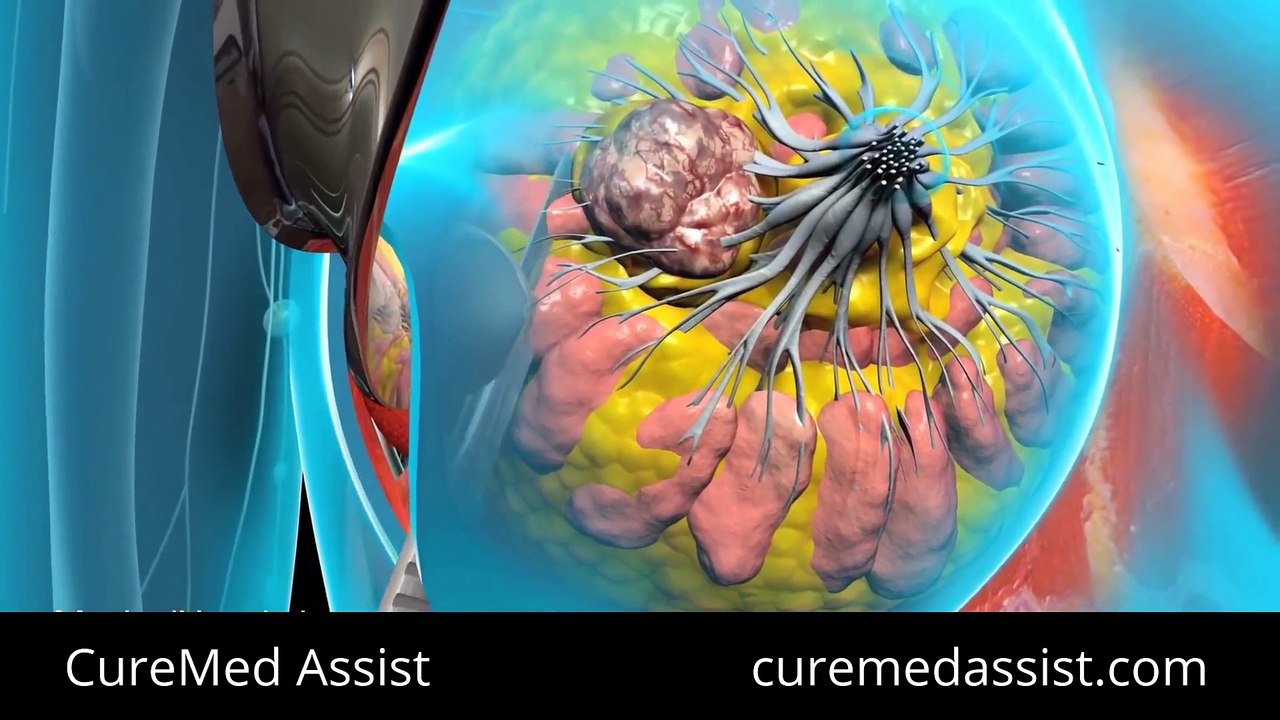 Surgery To Remove Entire Breast – CureMed Assist – Medical Tourism Company