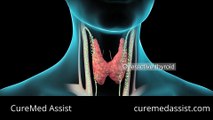 Thyroidectomy Thyroid Gland Thyroid Cancer Thyroid Surgery – CureMed Assist – Medical Tourism Co