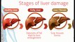 Alcoholic Liver Diseases