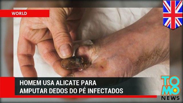 Homem usa alicate para amputar seus próprios dedos.