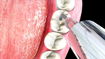 Sealants and Mouth Guards| Phan-tastic Smiles