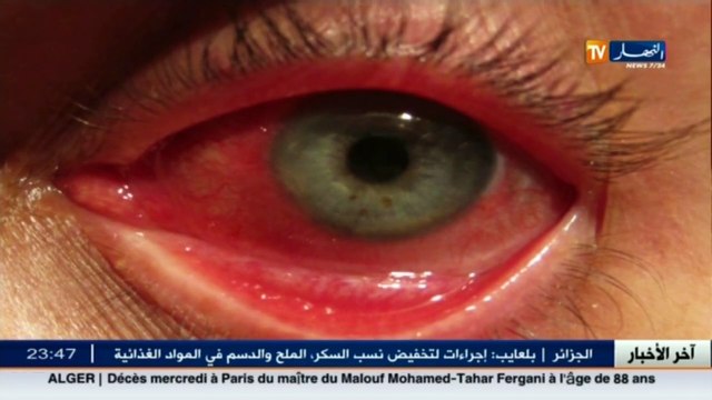 3 دقائق صحة مرض إلتهاب العيون.. نصائح وقائية من الدكتورة فايزة شاوش