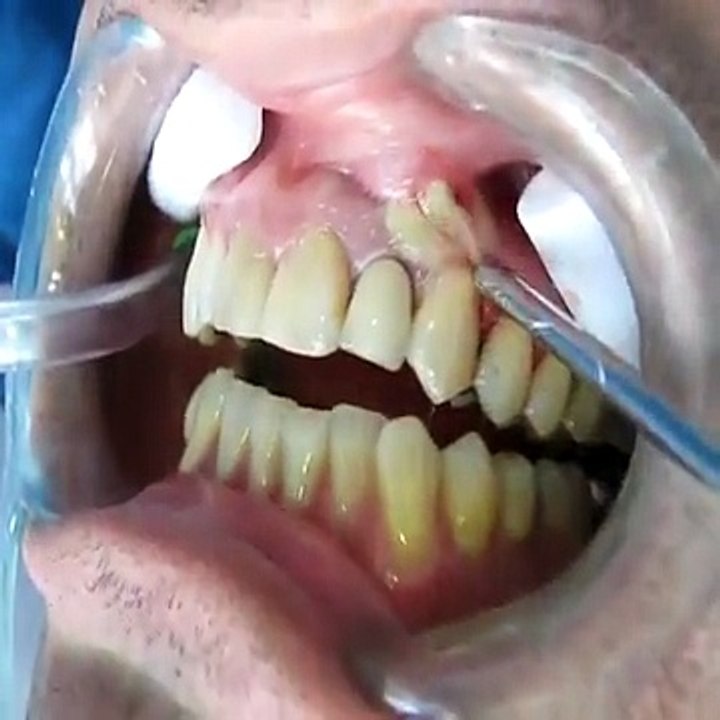 Un dentiste filme son opération sur un patient atteint d’un abcés