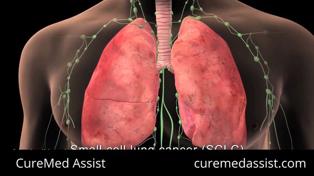 Types And Staging Of Lung Cancer – CureMed Assist – Medical Tourism Company