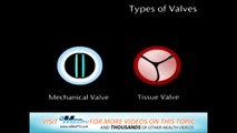 Types of Valves – CureMed Assist – Medical Tourism Company