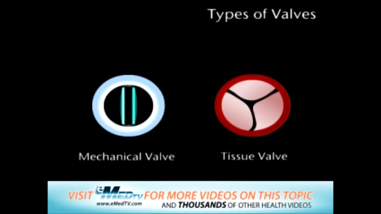 Types of Valves – CureMed Assist – Medical Tourism Company