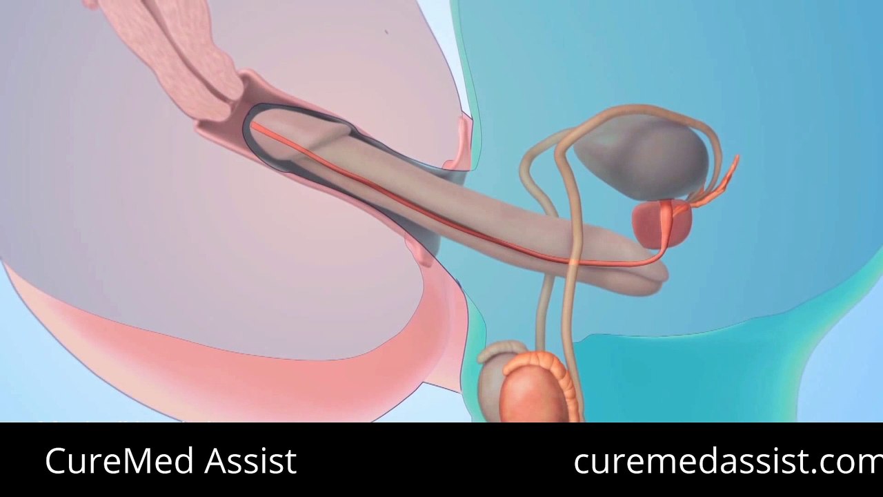 Use Cervical Cap To Avoid Pregnancy – CureMed Assist – Medical Tourism Company
