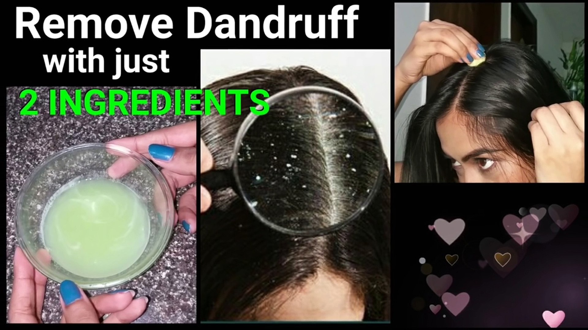 How to remove dandruff naturally at home