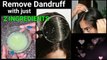 Magical Home Remedy to Remove DANDRUFF at home//Dandruff treatment/How to get rid of dandruff
