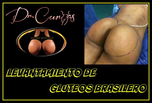 Revisión del levantamiento de glúteos brasilero