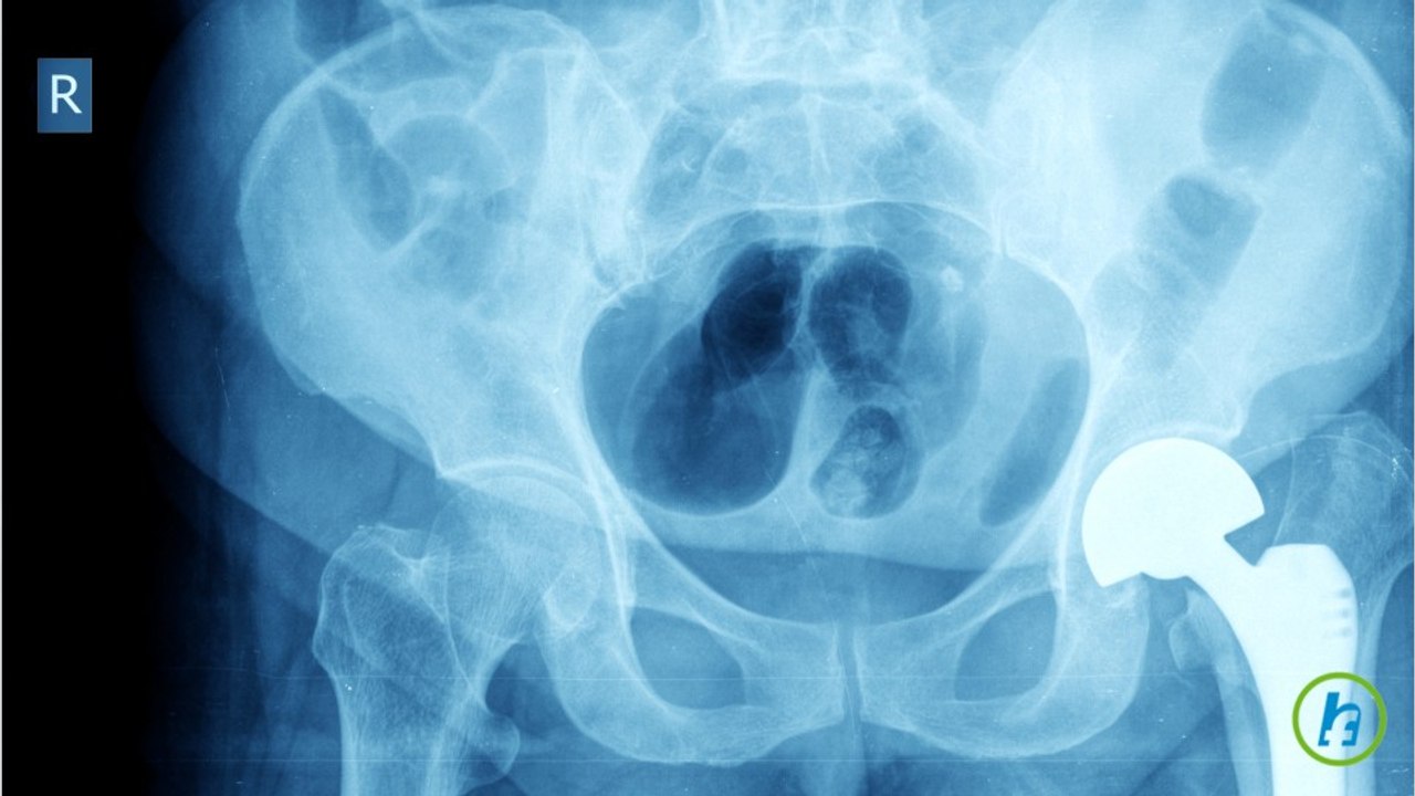Osteoartrita soldului