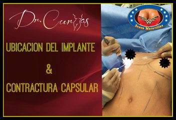 UBICACIÓN DEL IMPLANTE MAMARIO Y CONTRACTURA CAPSULAR