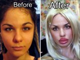 Plastic Surgery Gone Horribly Wrong - Worst Plastic Surgery Ever - Version 3