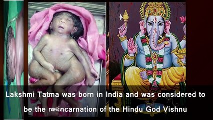 10 Terrifying Rare Birth Diseases In Babies