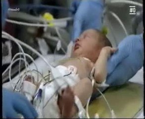 Cardiopatia congenita: Cirugia postnatal