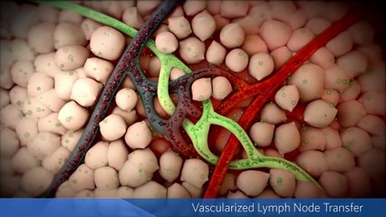 Vascularized Lymph Node Transfer – CureMed Assist – Medical Tourism Company