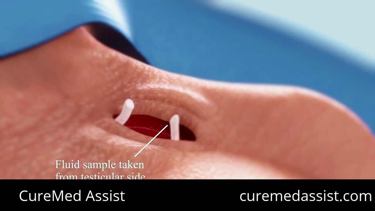 Vasovasostomy – CureMed Assist – Medical Tourism Company