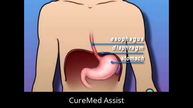 Patient Education Minimal Hernia Hiatal Laparoscopic – CureMed Assist – Medical Tourism Company