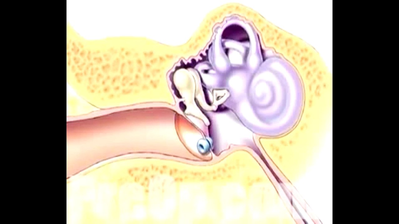 Patient Education Myringotomy Insertion of Tube 4 – CureMed Assist – Medical Tourism Company