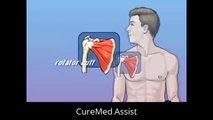 Patient Education Rotator Cuff Repair Open Surgery – CureMed Assist – Medical Tourism Company