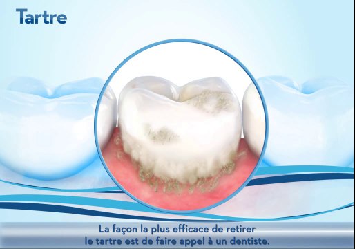 Le tartre - Prévention & Soins dentaires Oral-B