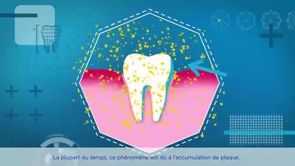 La gingivite et la maladie des gencives, c’est quoi ?