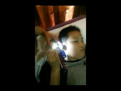DIY Ear Cleaning (1) Helping a boy to remove a large piece of ear wax