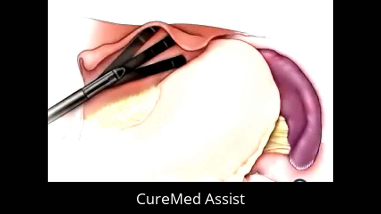 Patient Education Spleen Removal Laparoscopic Splenectomy Surgery 2 – CureMed Assist – Medical Tourism Company