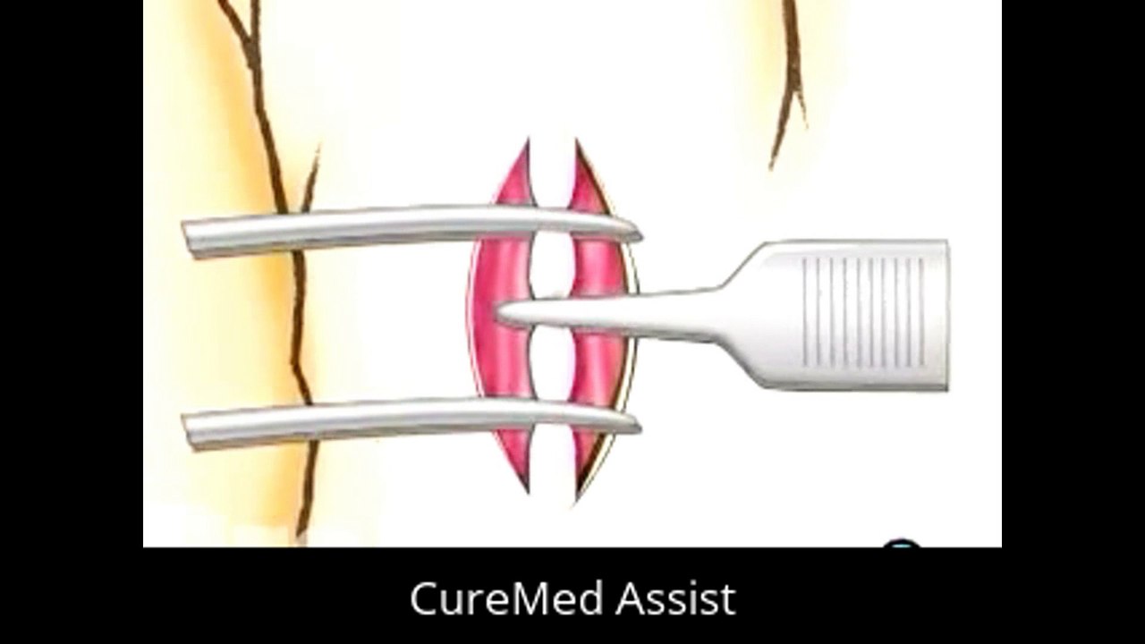 Patient Education Vasectomy Surgery – CureMed Assist – Medical Tourism Company
