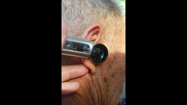 Chinese Ear Cleaning (36) Helping an old man to remove a large piece of ear wax