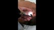 Chinese Ear Cleaning (66) Relaxation and Relief after massive removals of ear wax