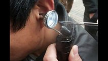Chinese Ear Cleaning (98) Helping a man to remove large amounts of ear wax